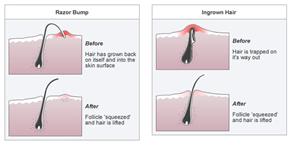 Anti Ingrown Hair Removal Cream